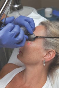 Keeping an Eye on Aging - Laser Eye Treatment